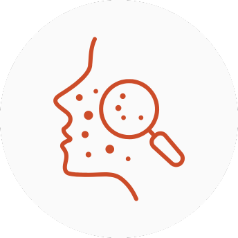 Acne and Scars Homoeopathy Treatment